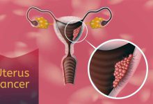 سرطان رحم در دختران