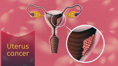 سرطان رحم در دختران
