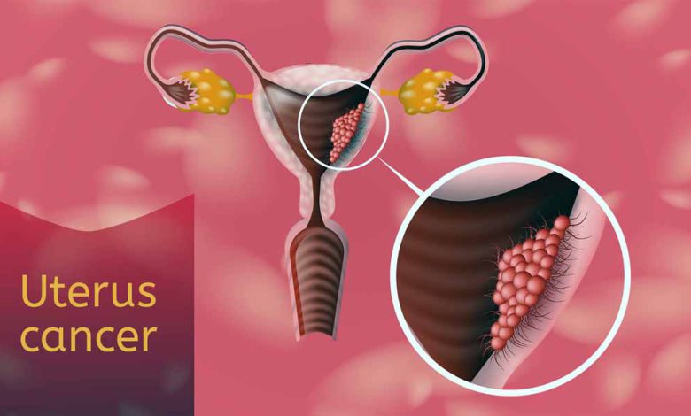 سرطان رحم در دختران