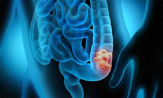 سرطان روده