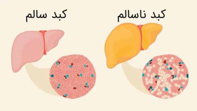 فرق چربی خون با کبد چرب