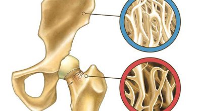 درصد خطرناک پوکی استخوان و درصد نرمال