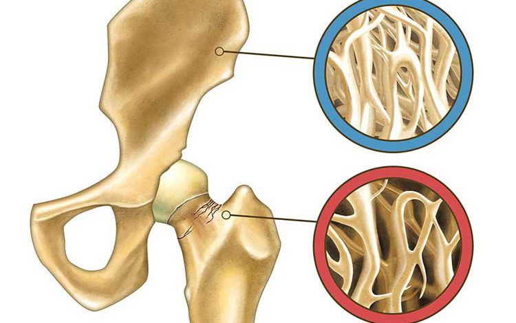 درصد خطرناک پوکی استخوان و درصد نرمال