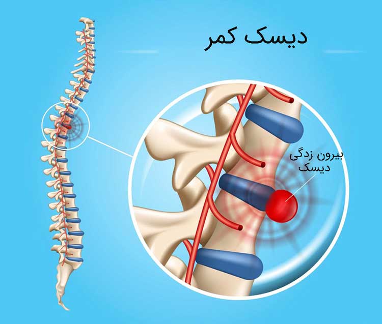 دیسک کمر