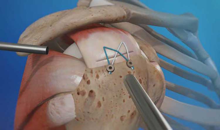 پارگی تاندون شانه