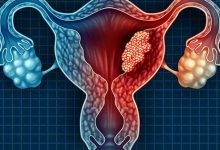 مهمترین علایم سرطان رحم در یائسگی و بهترین راه تشخیص